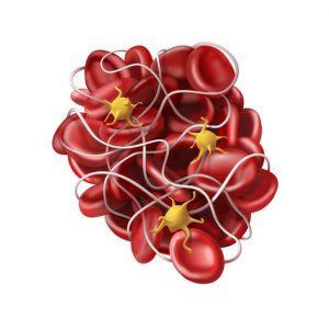 A cartoon blood clot, with red blood cells shown bound by white fibrin filaments. Fibrin formation involves thrombin-mediated proteolytic cleavage of fibrinogen. Credit: Getty Images/iStockphoto.