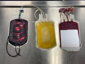 L - R: Platelet buffy coat, plasma, and red blood cells after the separation of whole blood components. 
